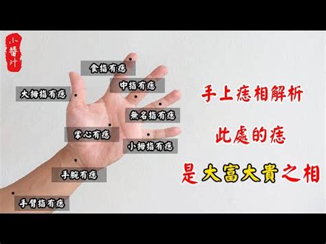 左手胎記|手上的胎記是什麼意思 